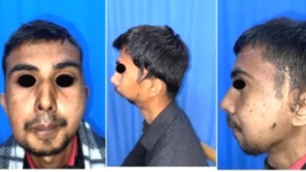 एम्स गोरखपुर में बर्ड फेस डिफॉर्मिटी से पीड़ित युवक